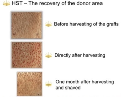 recovery of the donor area